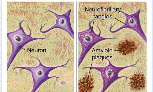 ammassi-neurofibrillari-che-circondano-i-neuroni-nel-cervello-con-alzheimer